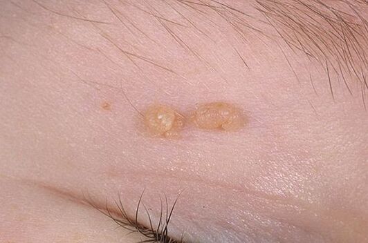 Obyčejný papilloma