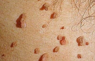 Jak se virus lidského papilomu projevuje