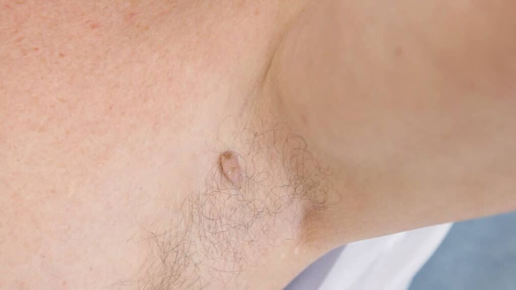 Film Papilloma