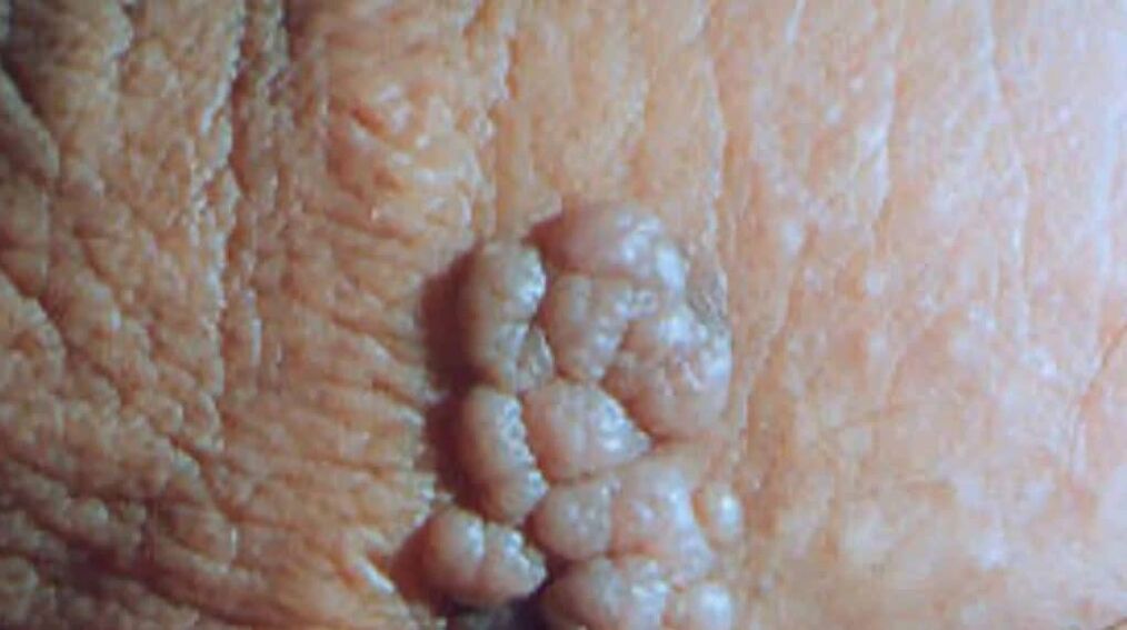 Sharp Condyloma