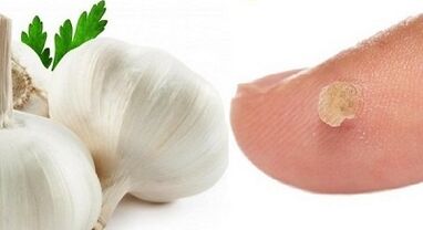 léčba bradavic lidovými prostředky