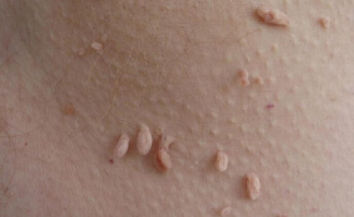 důvody pro výskyt papilomů na lidském těle