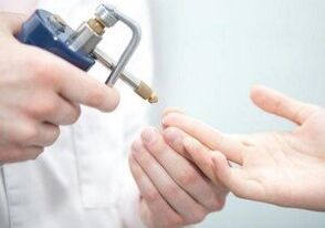 moderní metody odstraňování papilomů