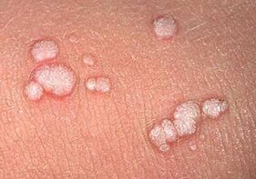 vulgární papilomy na lidském těle