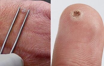 příznaky papilomů na lidském těle