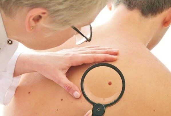 lékař určuje typ papilomu na kůži